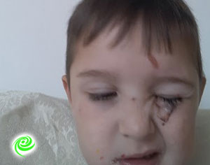 בן 4 נפגע ליד עינו מברזל חלוד שבולט במדרכה